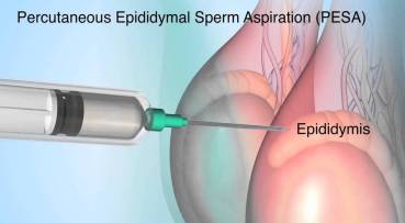 Percutaneus Epididy mical Sperm Aspiration